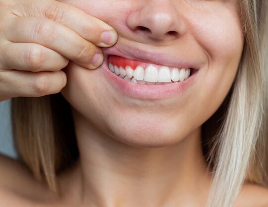 Gingivectomia en Granada | Clínica Dentalmar